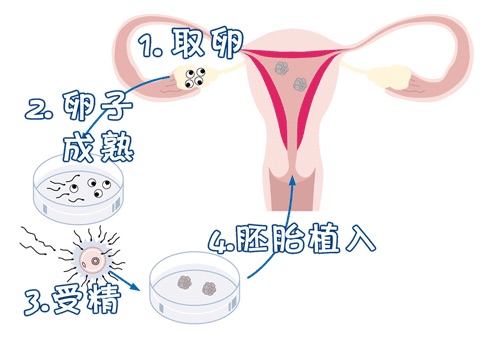 试管代孕费用多少